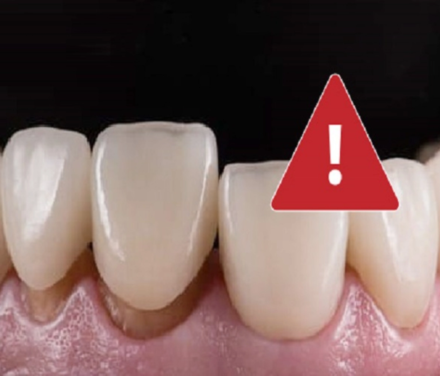 Hối hận khi bọc răng sứ: Sự thật và cách tránh sai lầm đáng tiếc